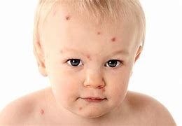 Chicken Pox Bahasa Indonesia